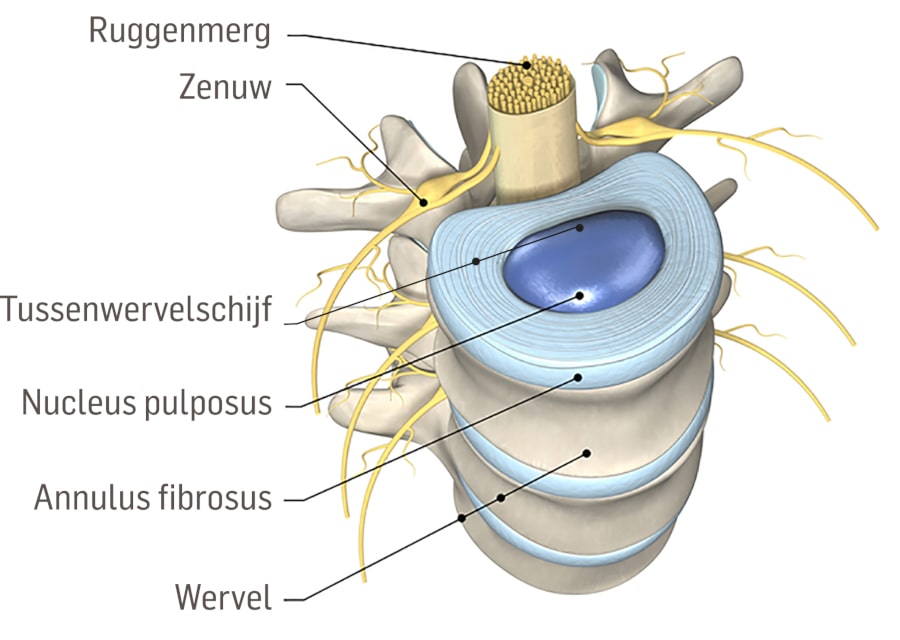 tussenwervelschijf