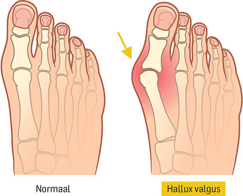 hallux valgus